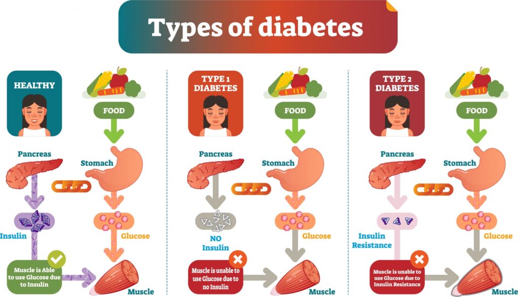 type of dibates by World Diabetes Day 2024